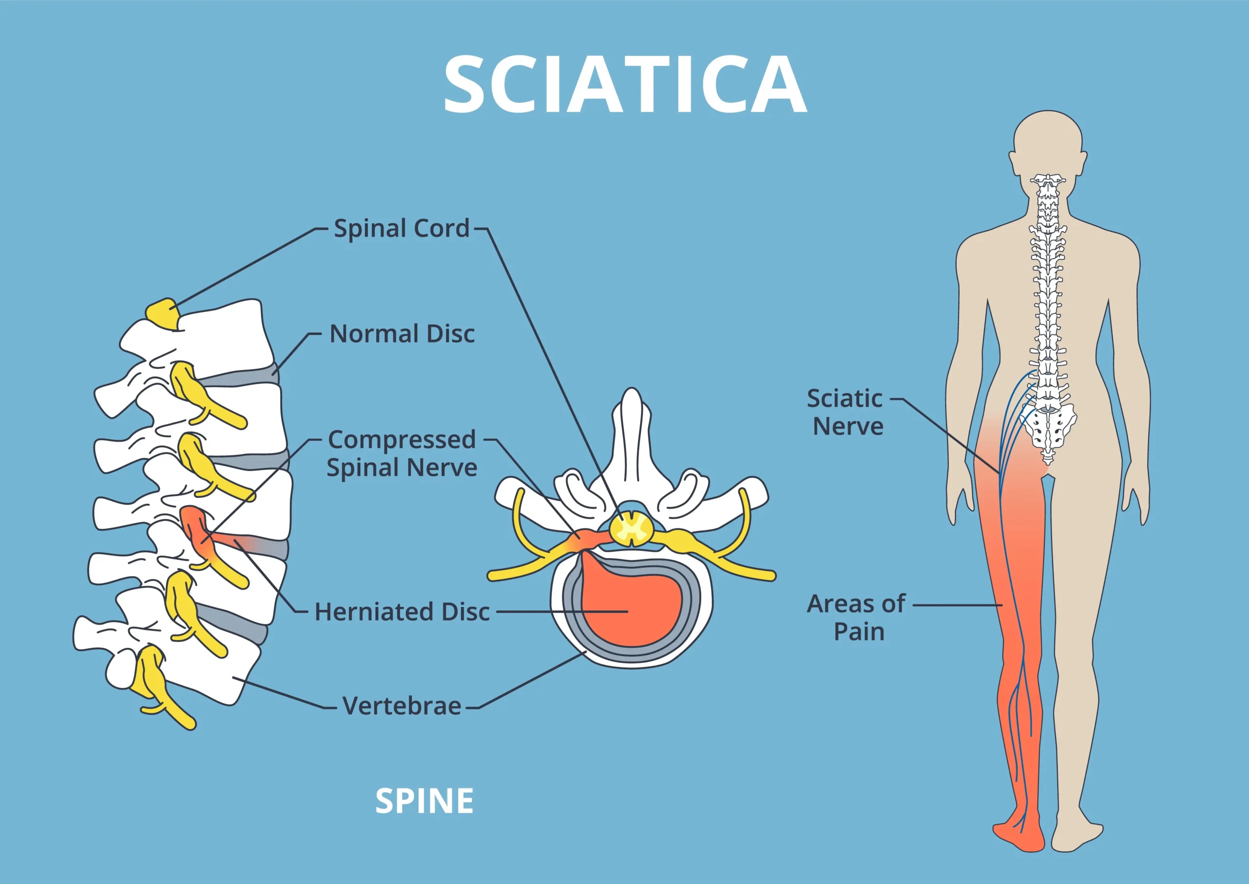 sciatic pain after a car accident